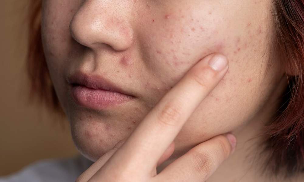 Winter Acne: Everything You Need To Know