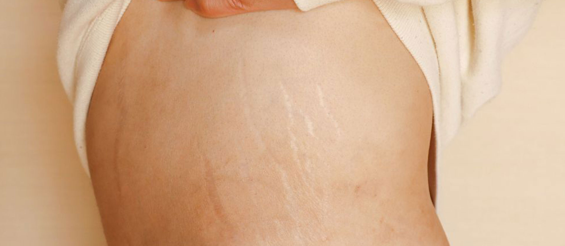 Laser for Stretch Mark