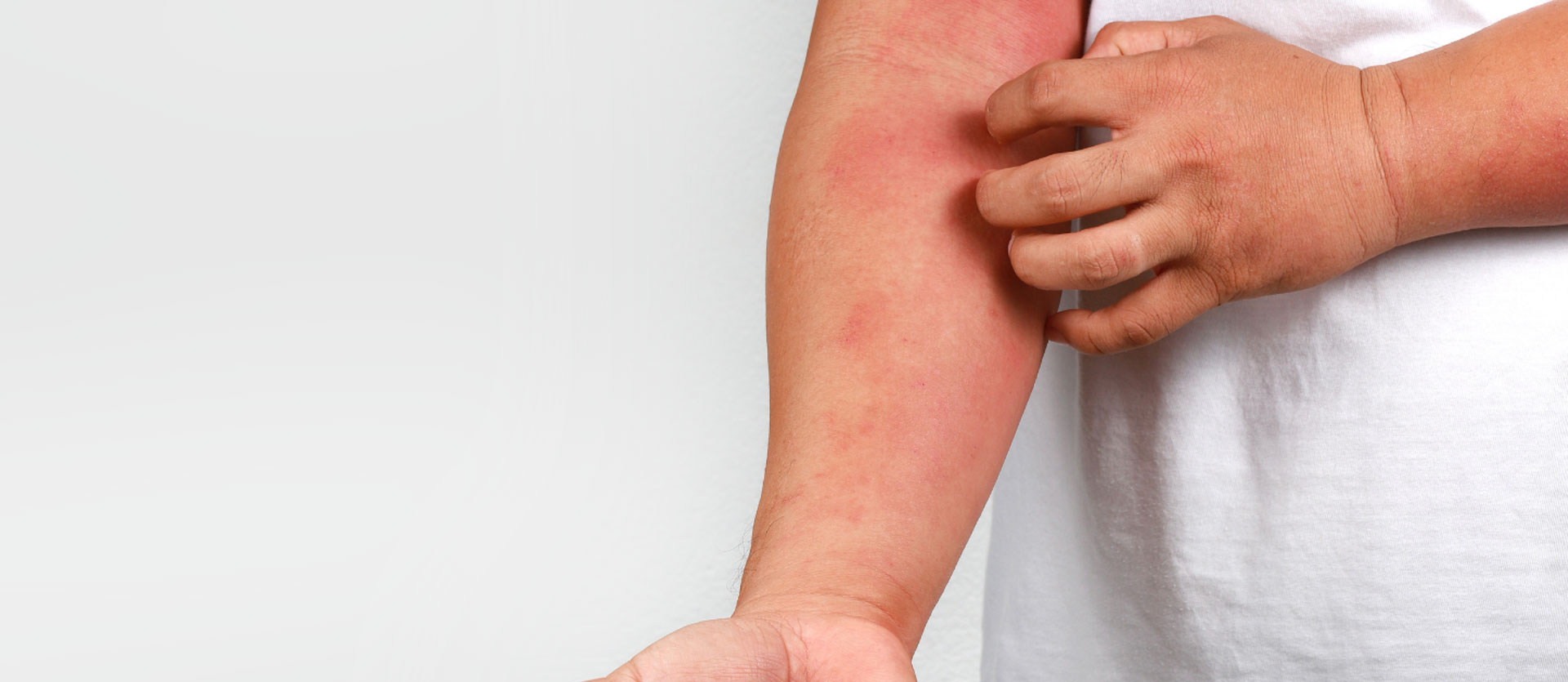 Eczema / Allergy