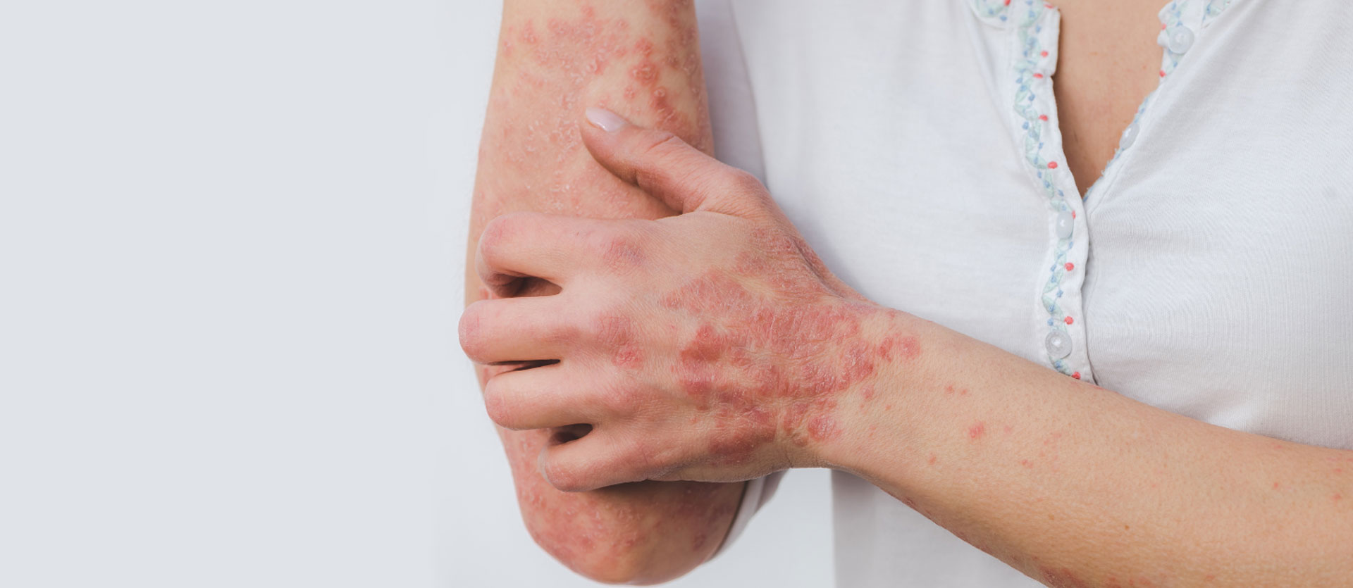 Psoriasis