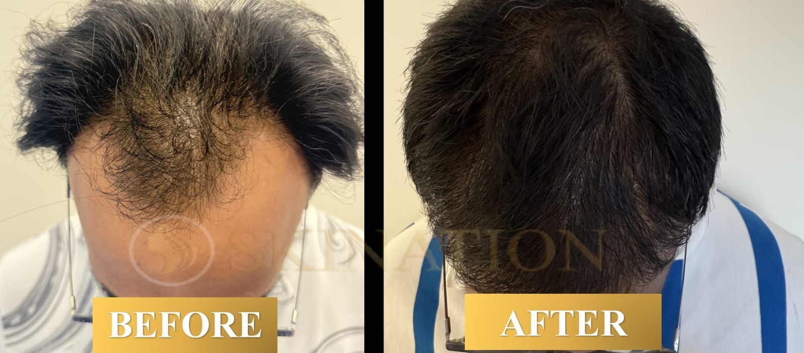 Hair Transplant in Delhi NCR