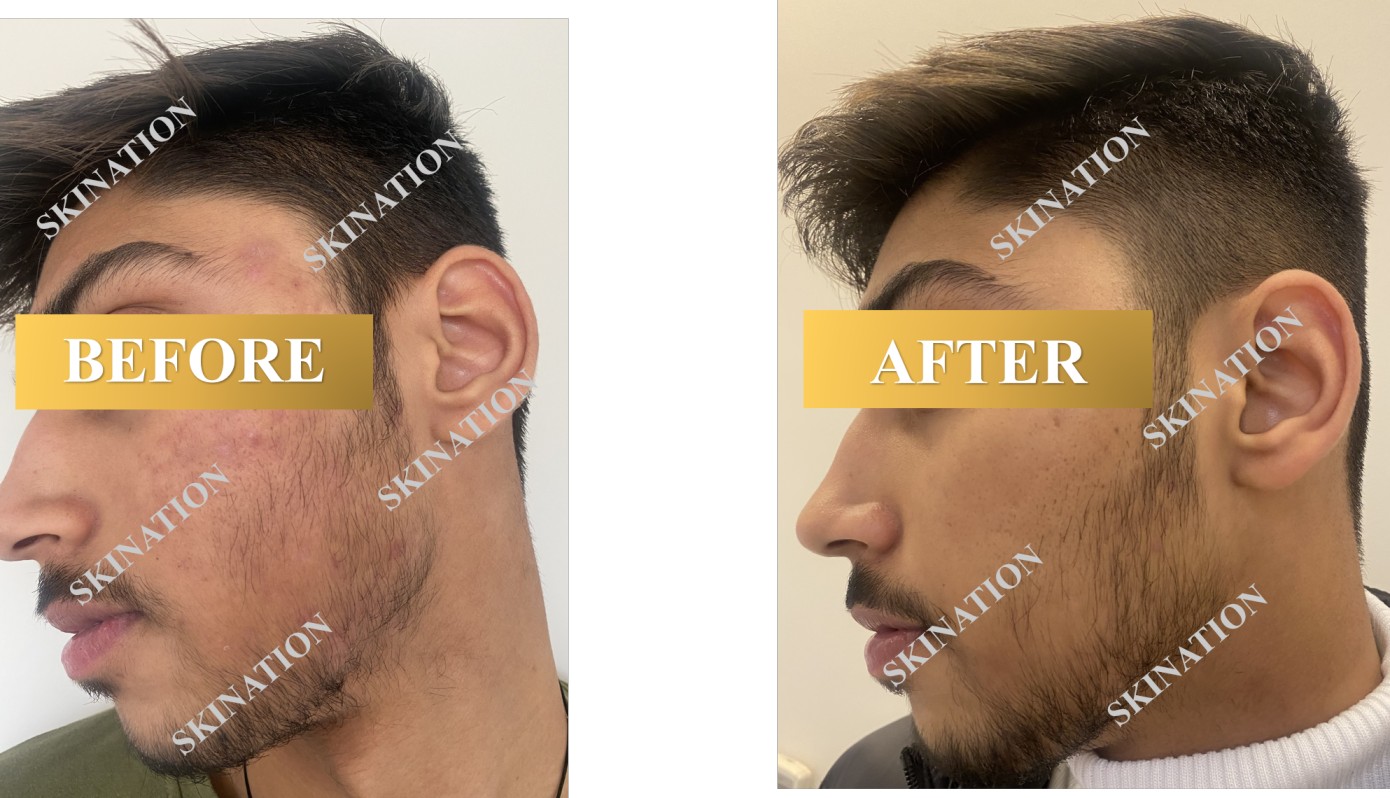 Acne Scar