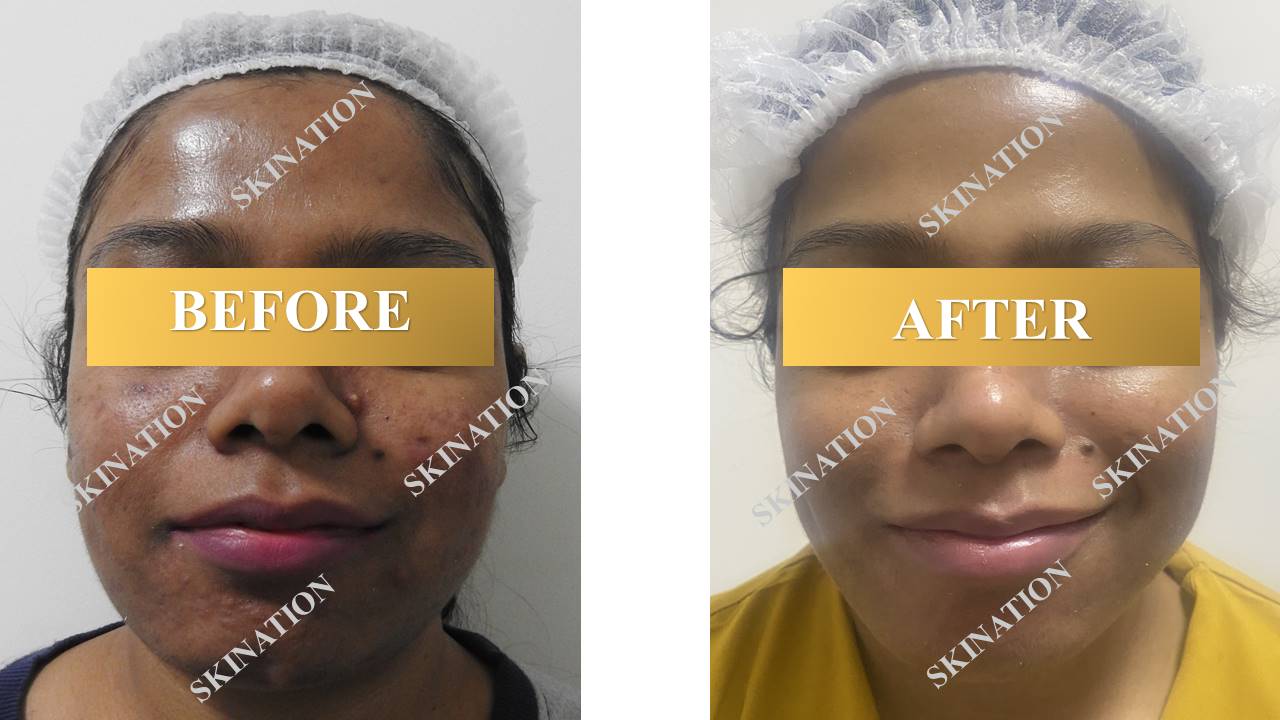 Laser Pigmentation
