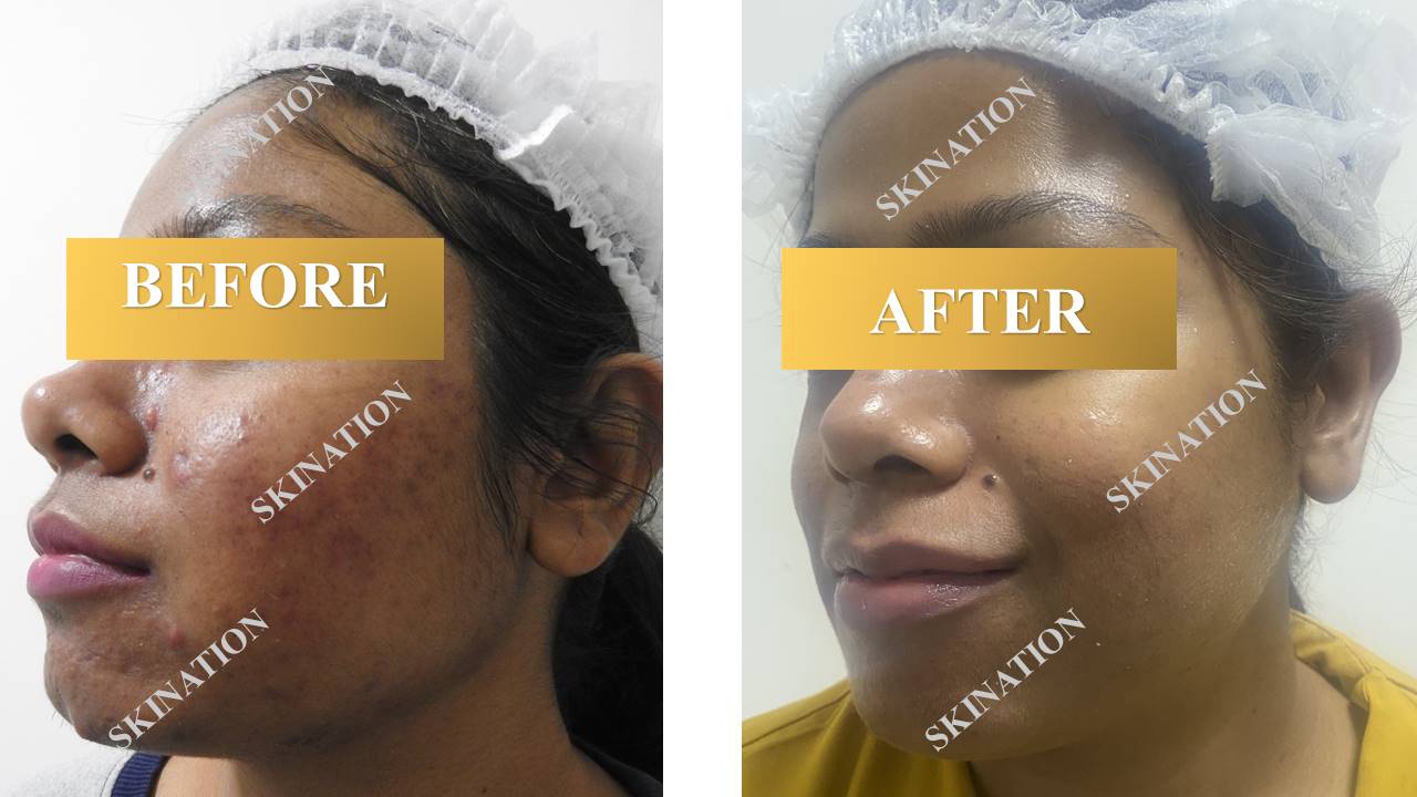 Laser Pigmentation