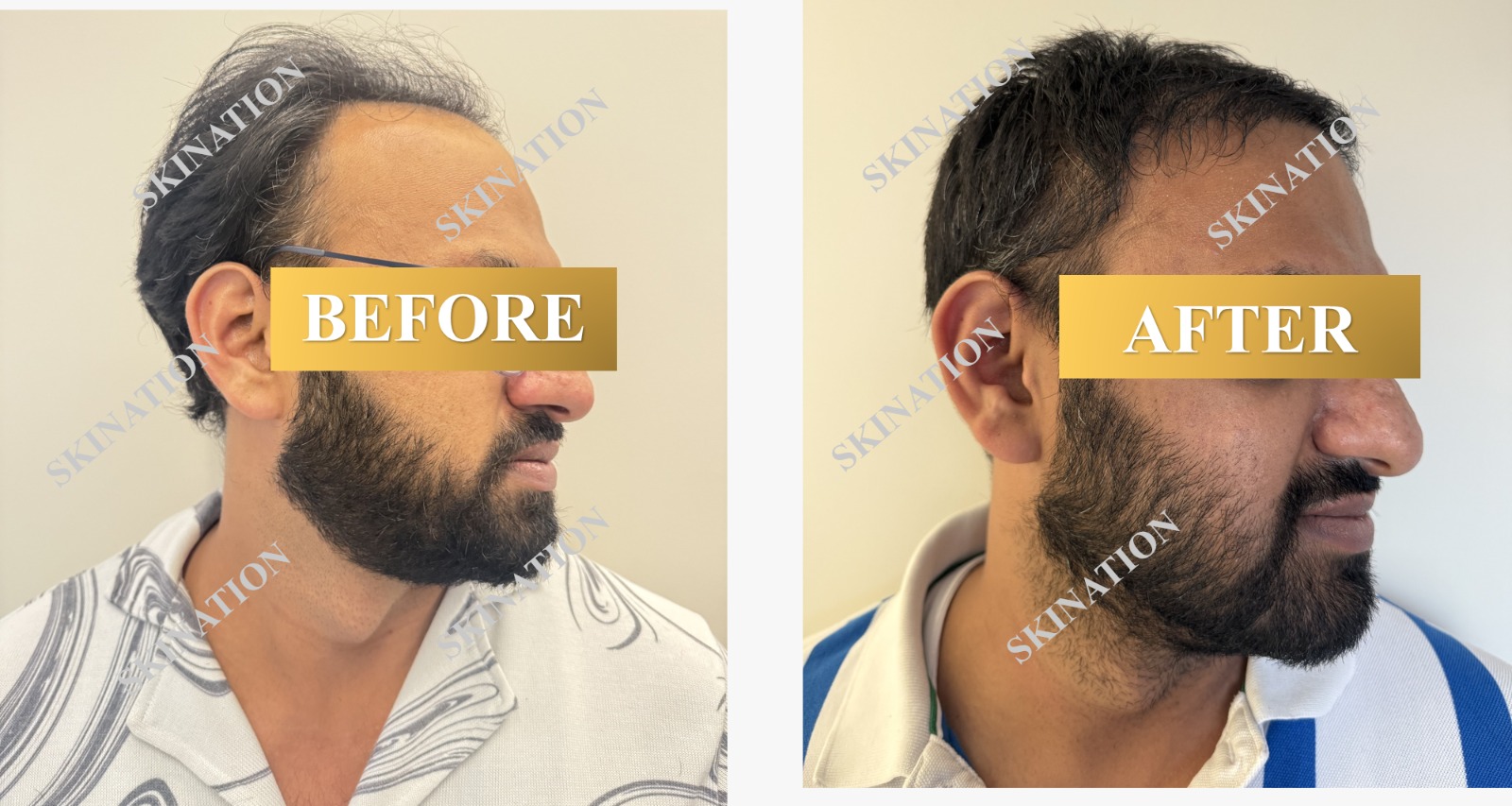 Hair Transplant