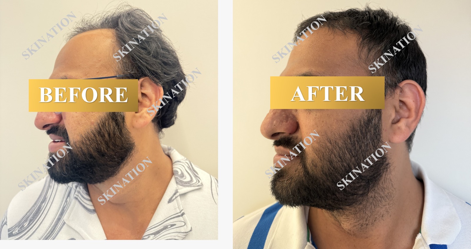 Hair Transplant