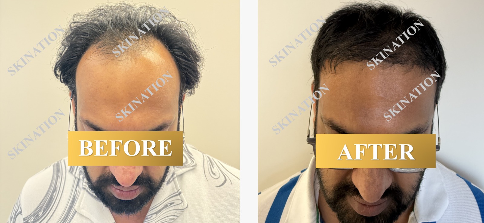 Hair Transplant