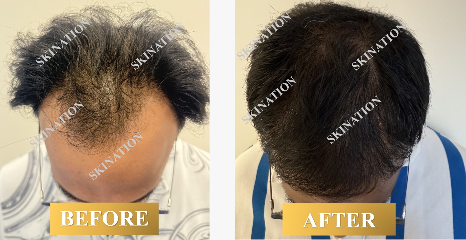 Hair Transplant