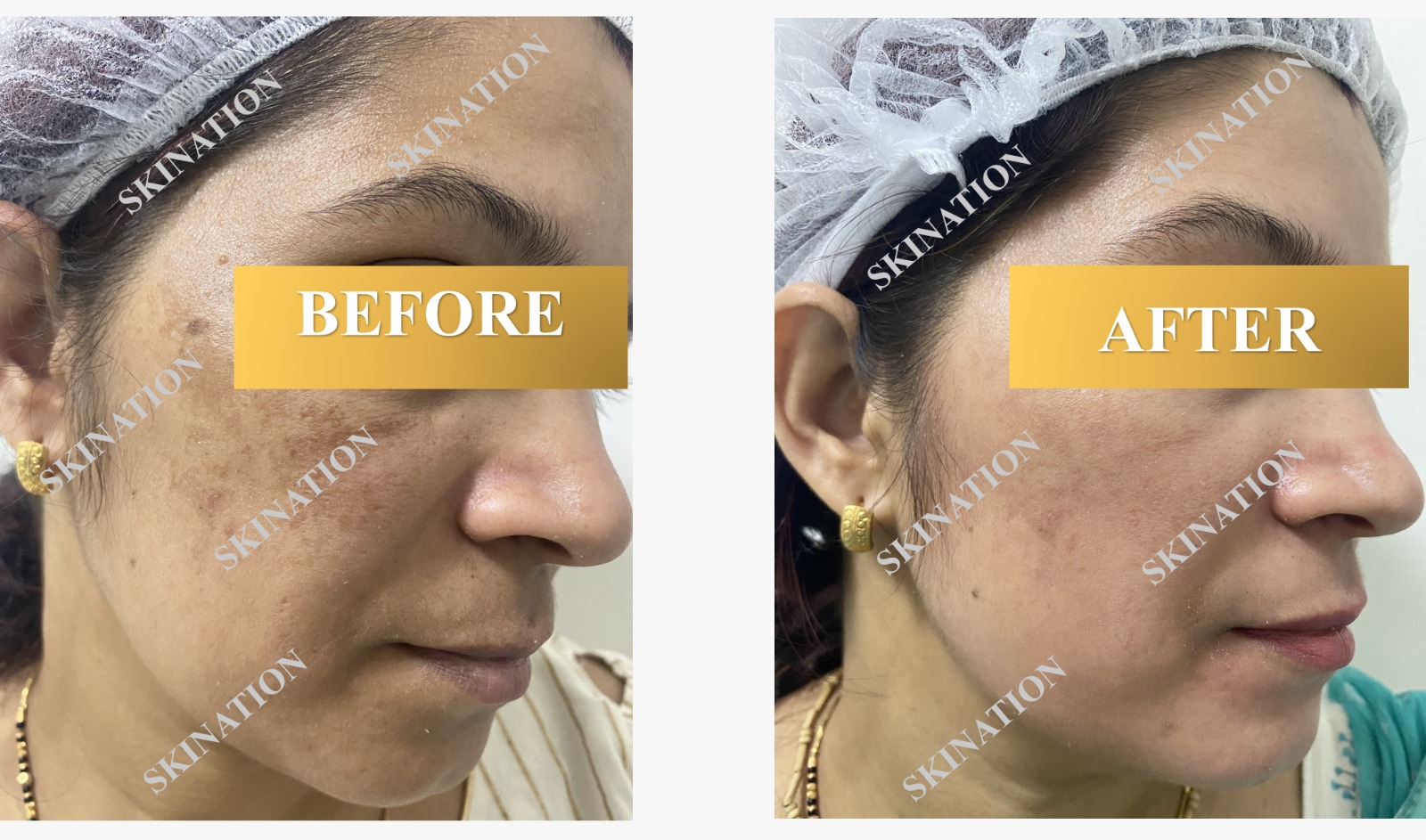 laser Pigmentation