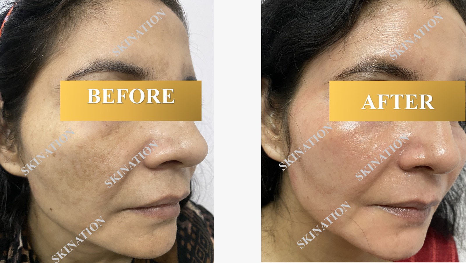 Laser Pigmentation