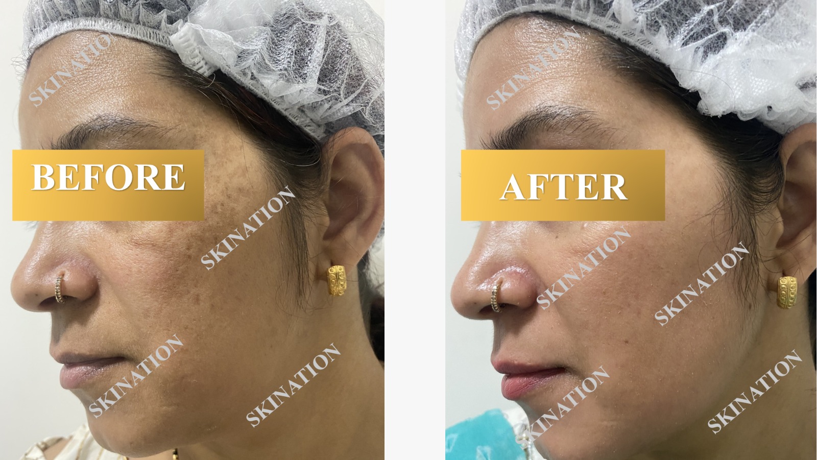 Laser Pigmentation