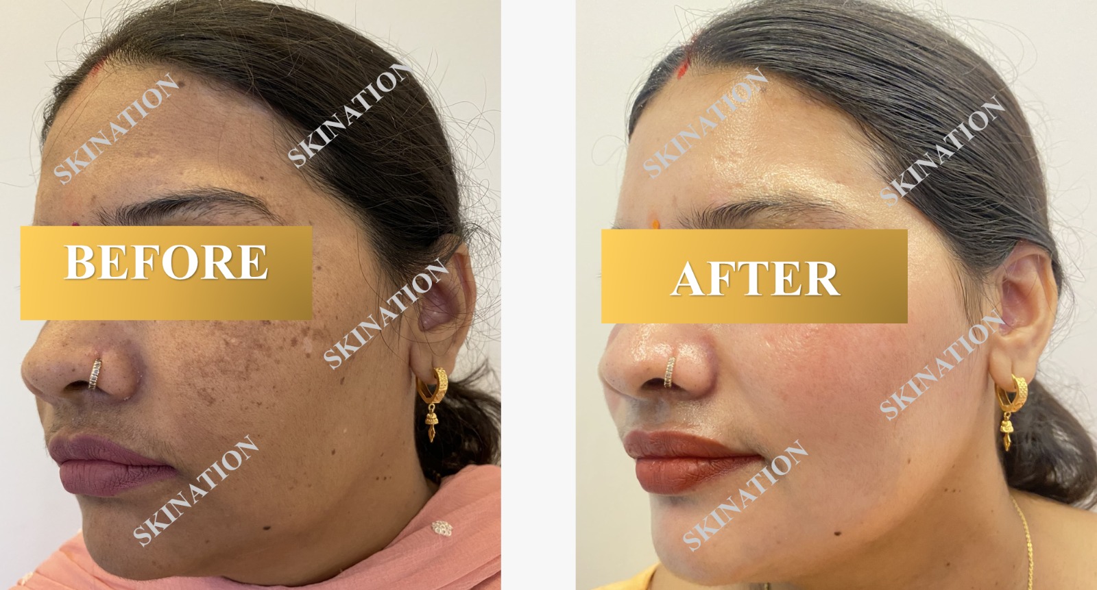Laser Pigmentation