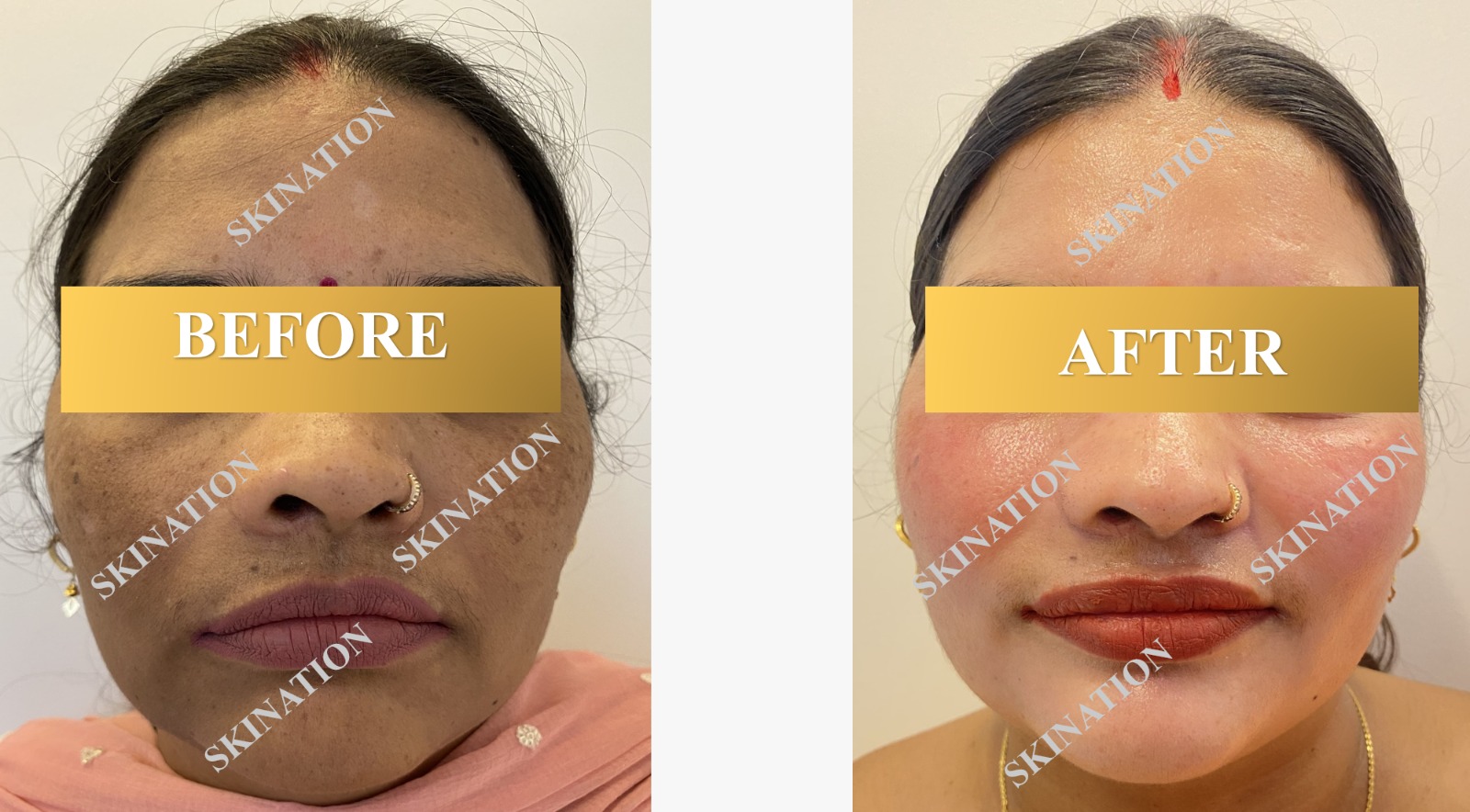 Laser Pigmentation