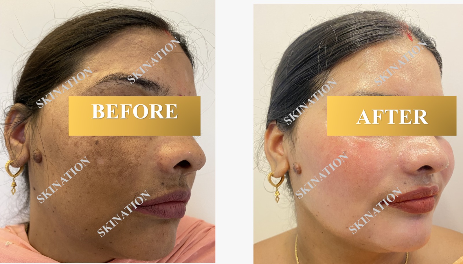 Laser Pigmentation