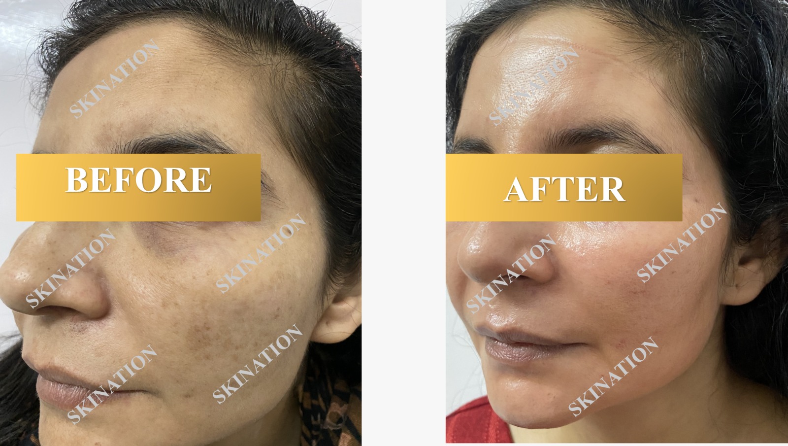 Laser Pigmentation