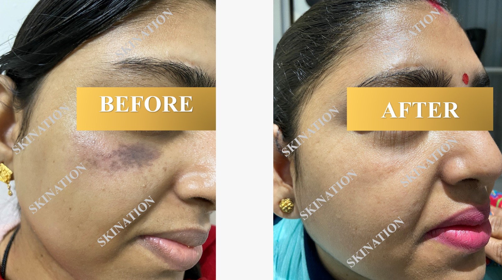 Laser treatment