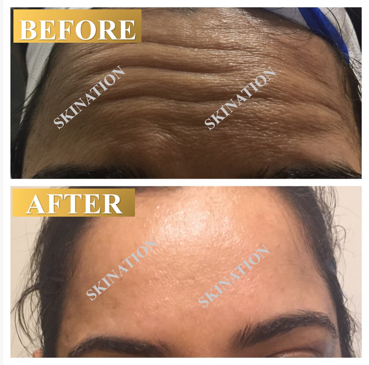Forehead Wrinkle Reduction