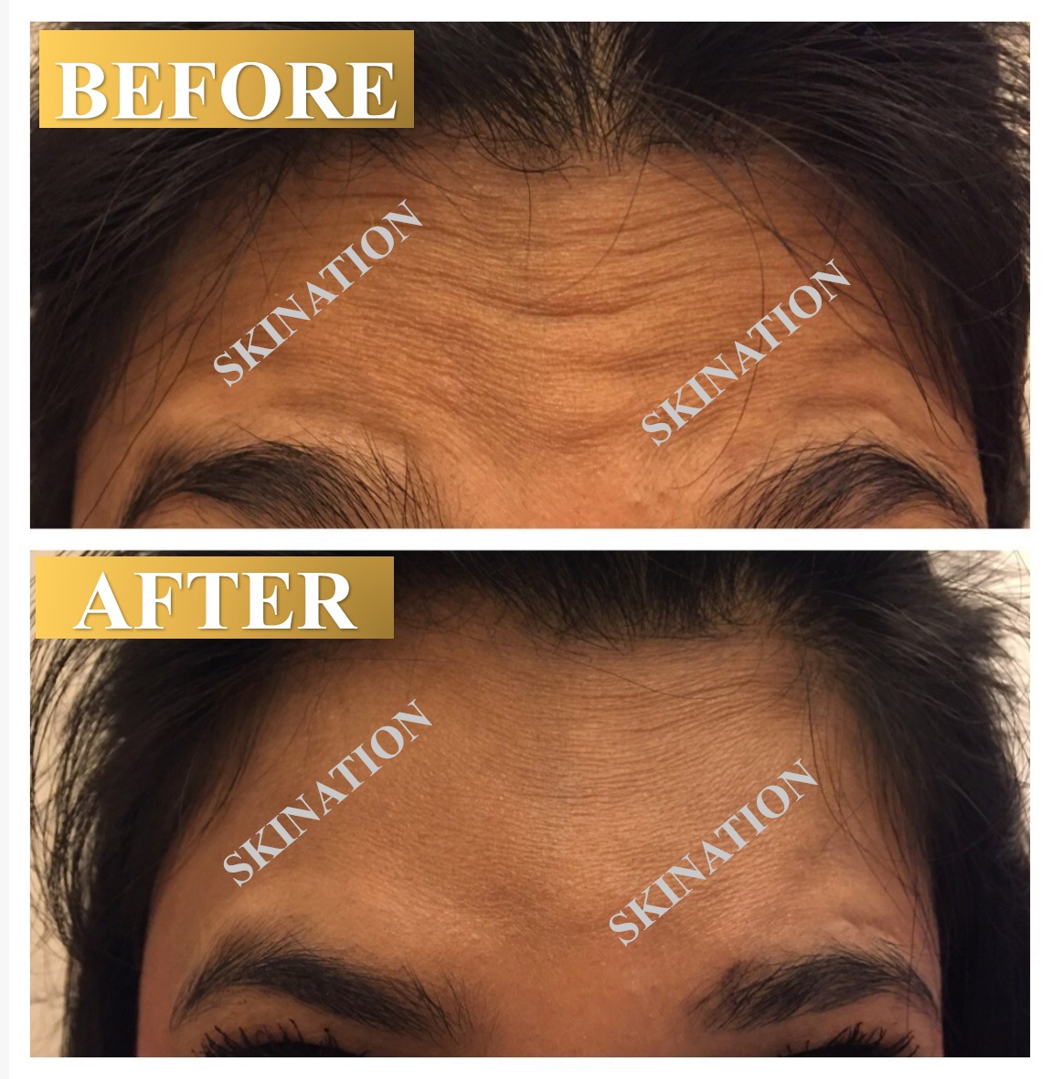 forehead wrinkle reduction