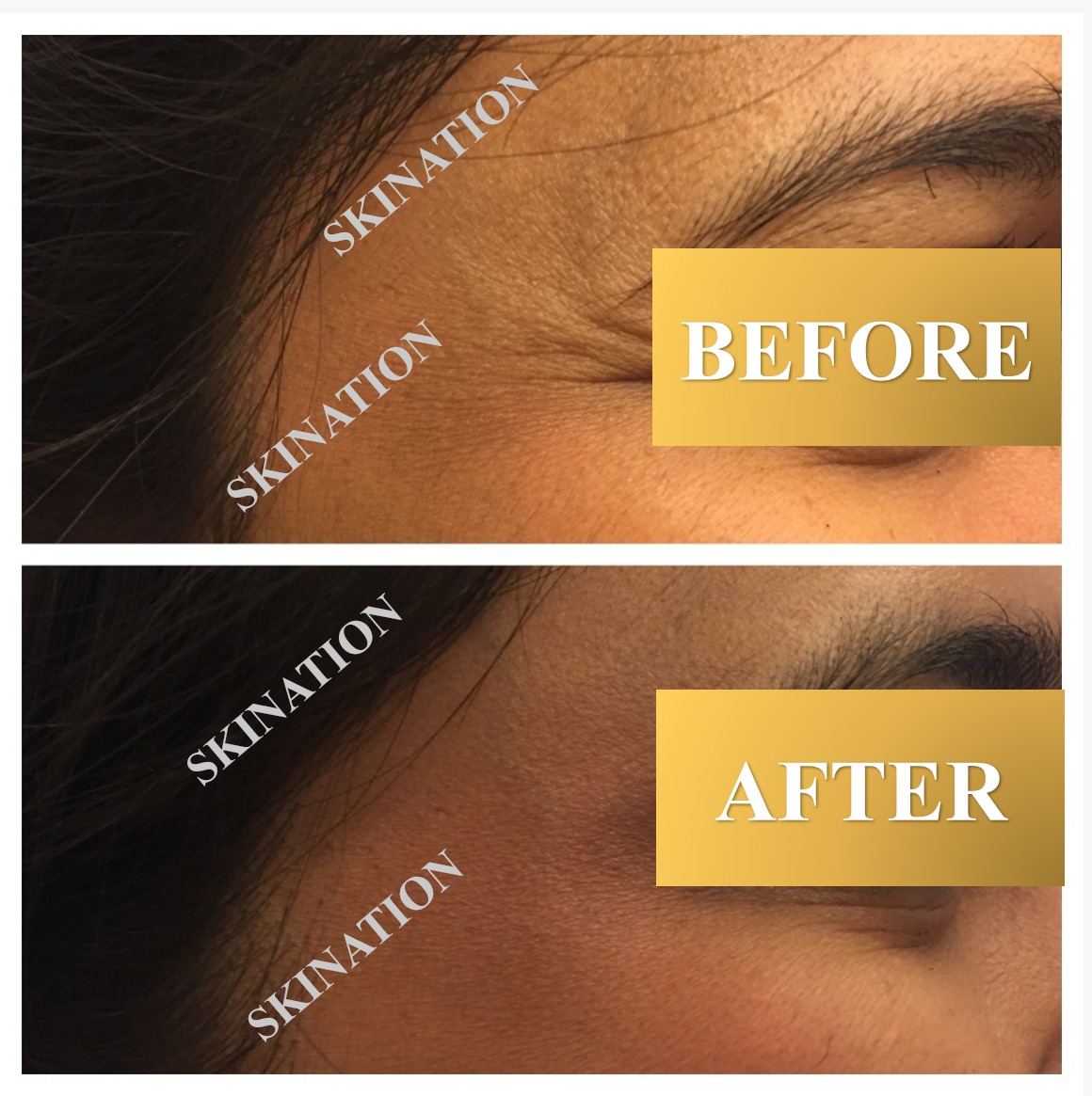 Wrinkle Reduction