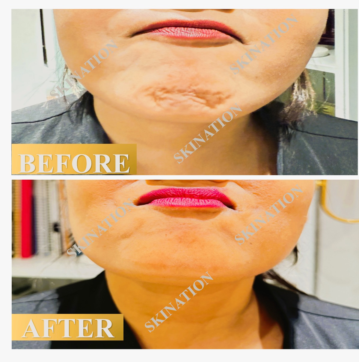 Popply Chin Wrinkle Reduction