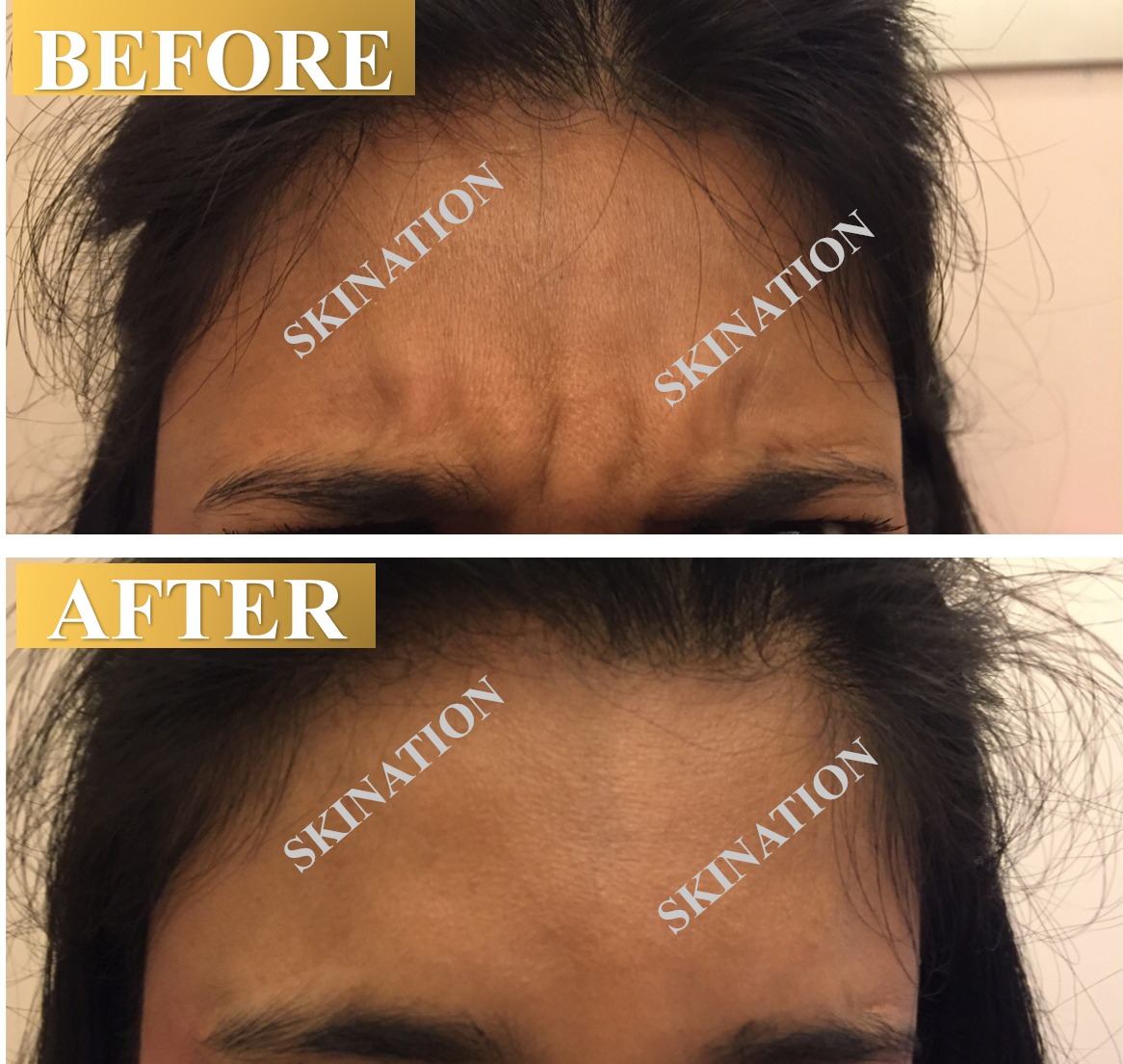 Frown Wrinkle Reduction
