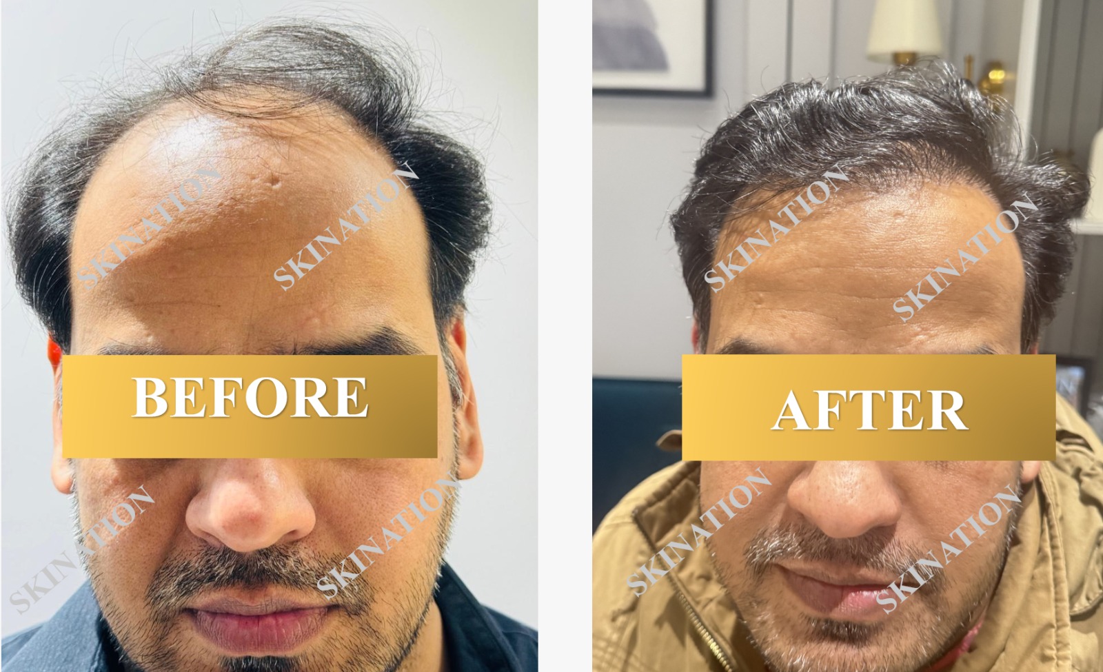 Hair Transplant