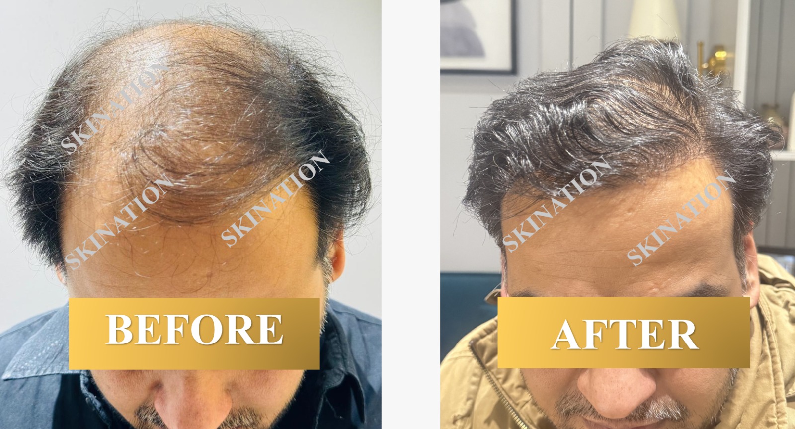 Hair Transplant
