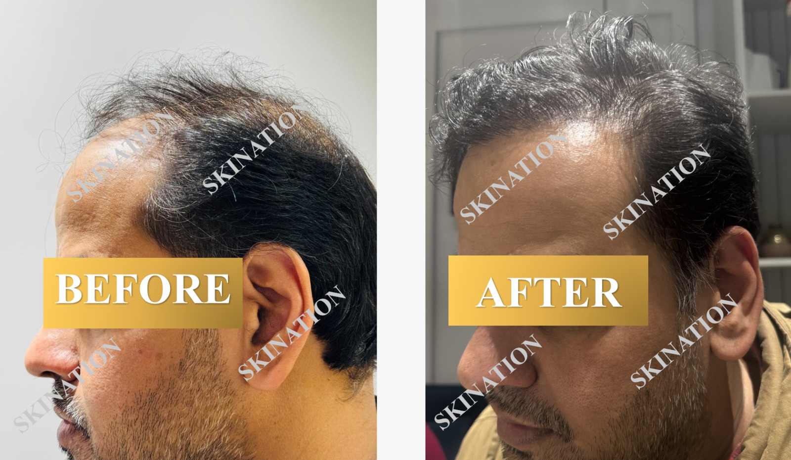 Hair Transplant