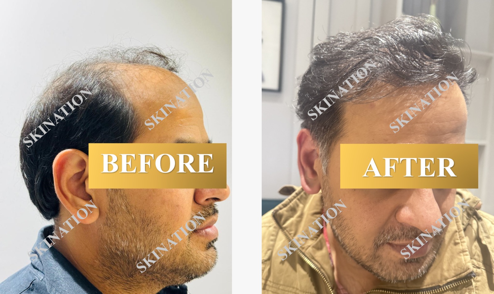Hair Transplant