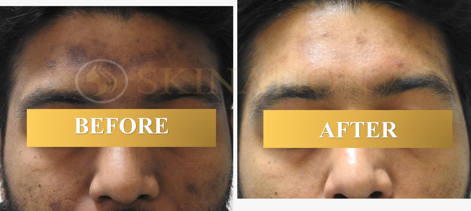 Laser Pigmentation