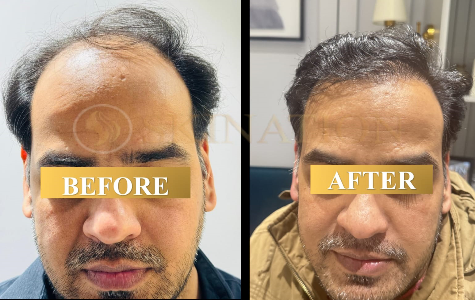 Hair Transplant