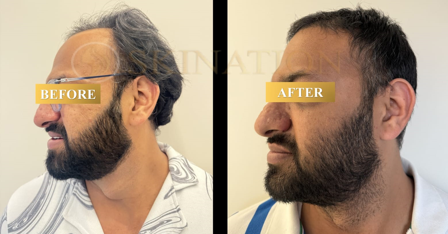 Hair Transplant