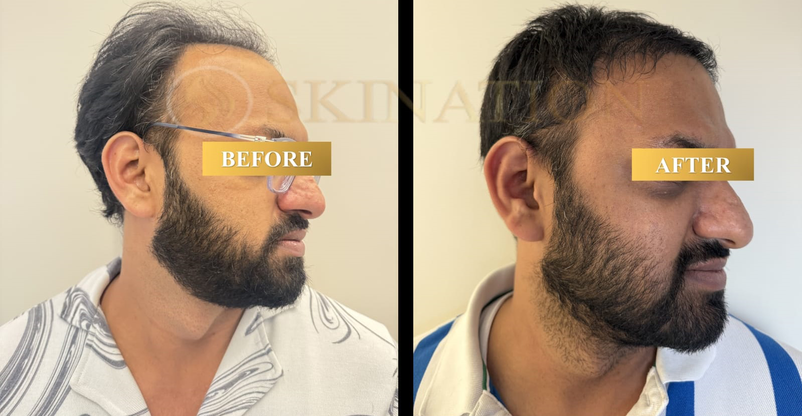 Hair Transplant