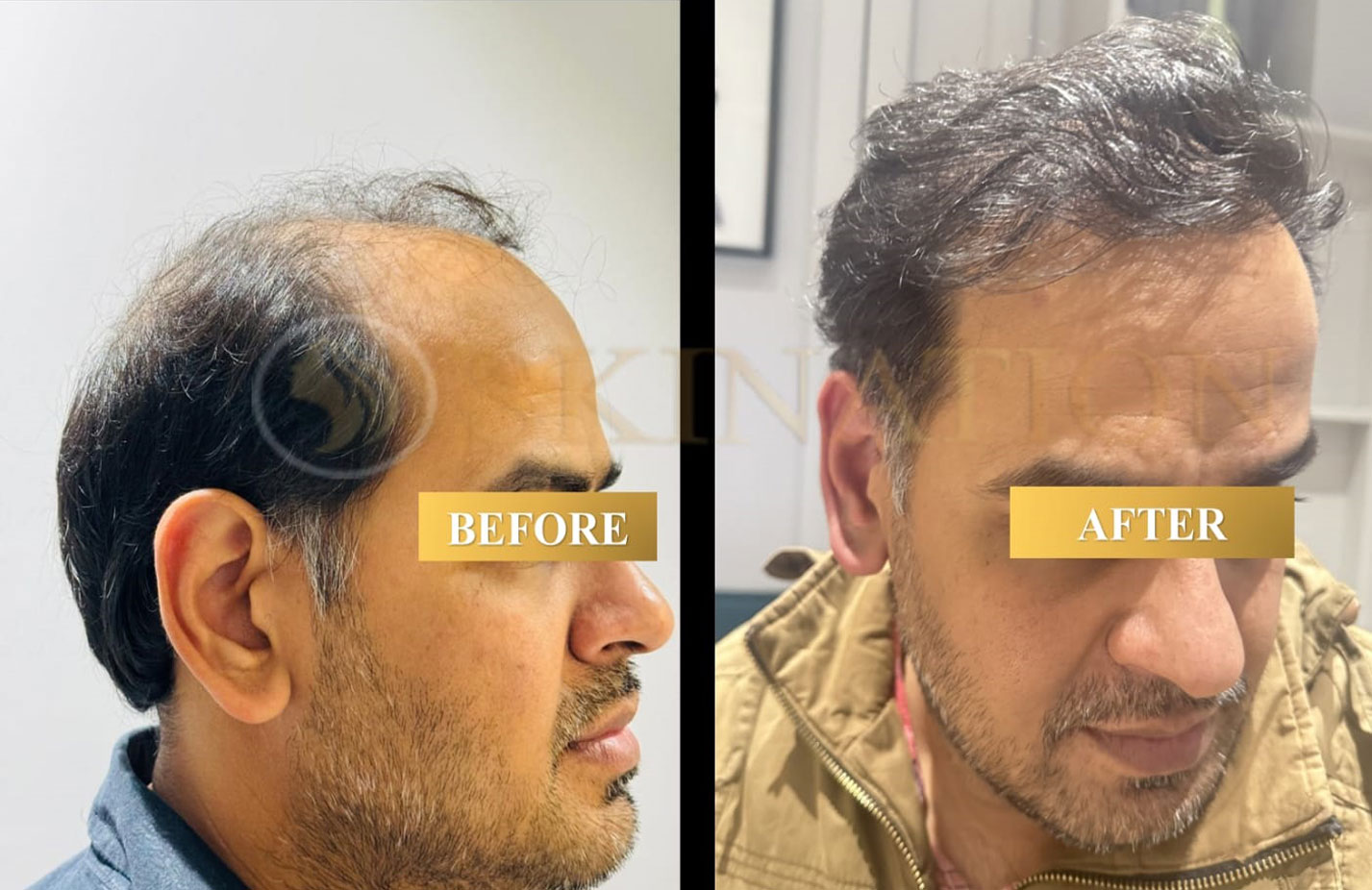Hair Transplant
