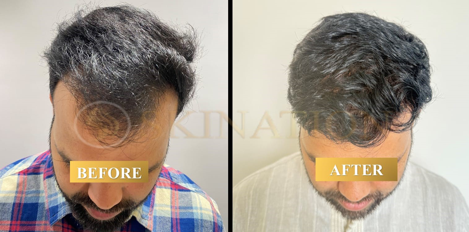 Hair Transplant in Faridabad