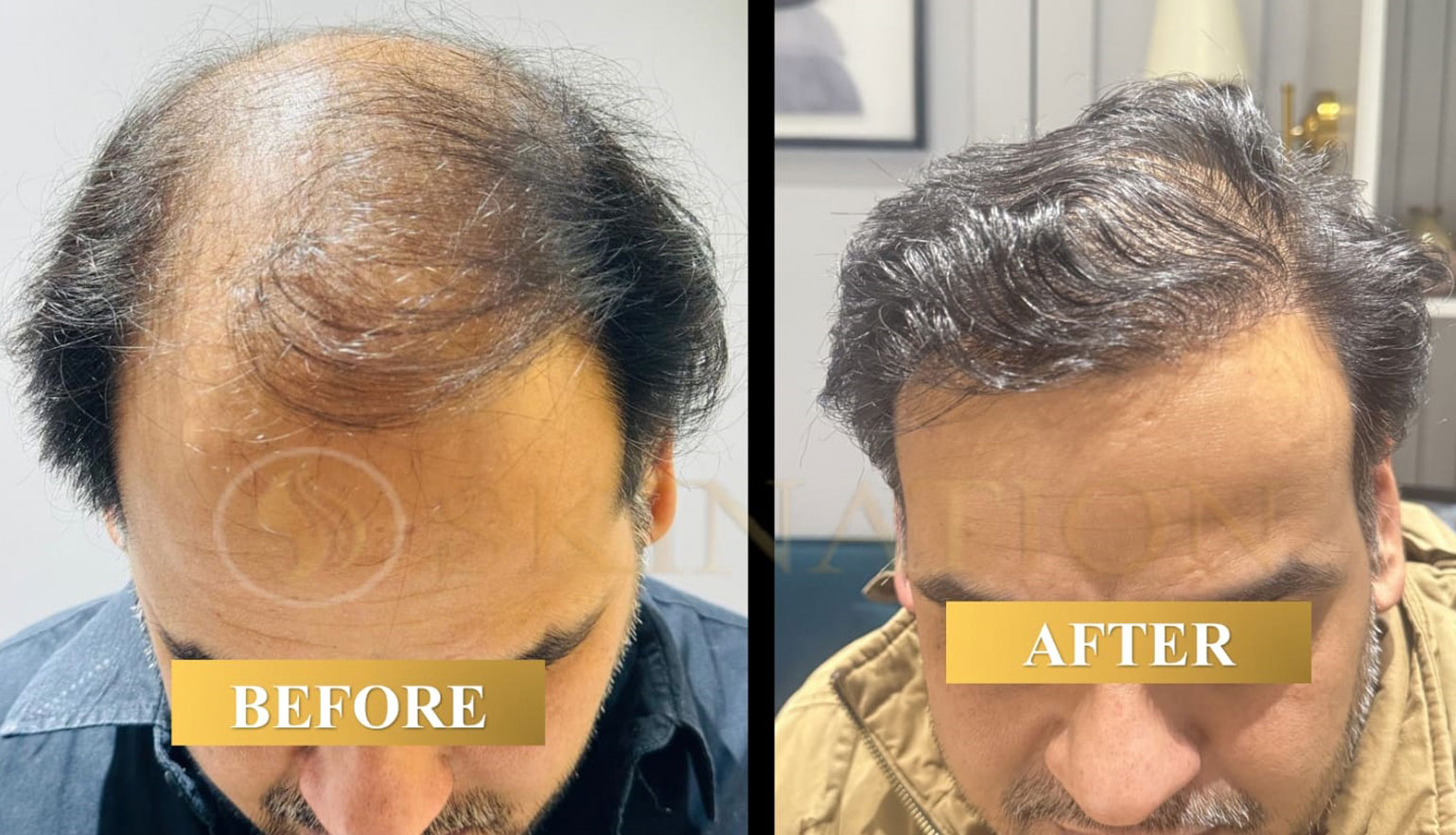 Hair Transplant