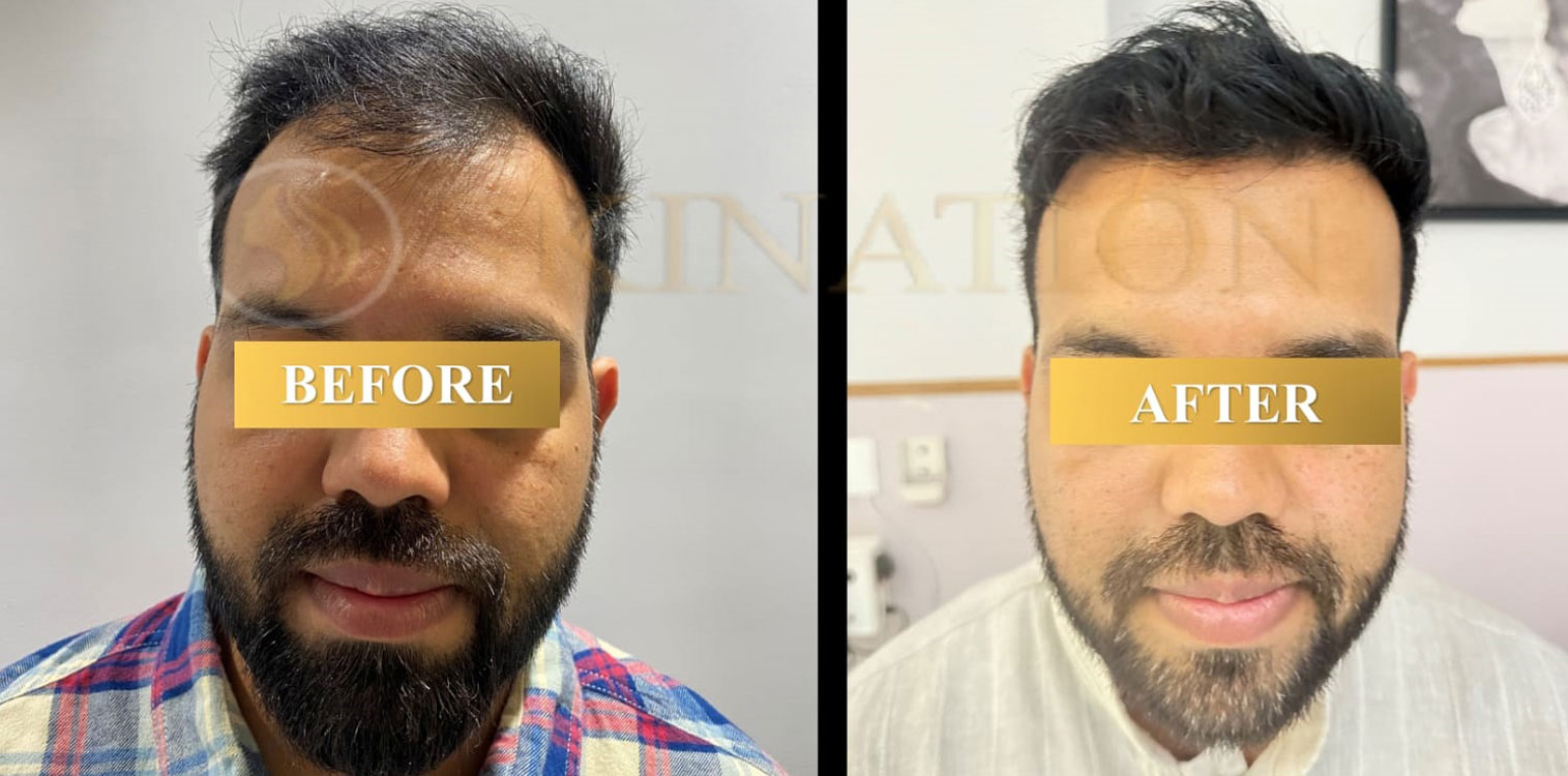 Hair Transplant in Chattarpur south Delhi