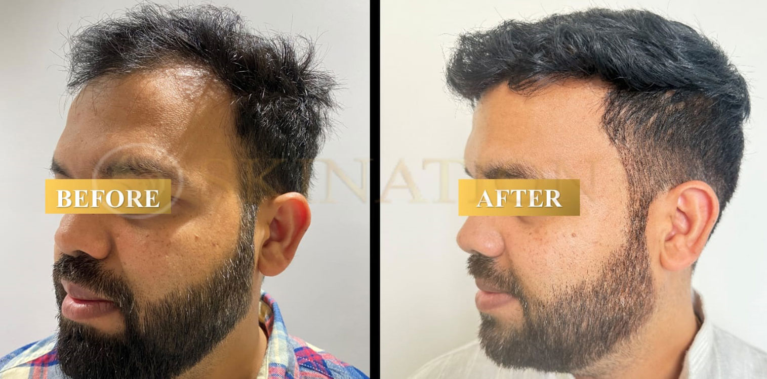 Hair Transplant in Faridabad