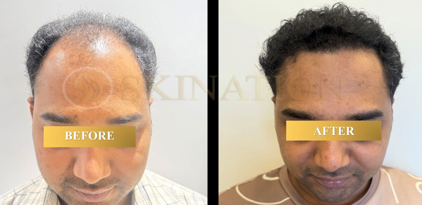 Hair Transplant in Chattarpur south Delhi