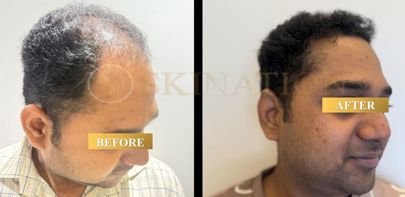 Hair Transplant in rajpur south delhi