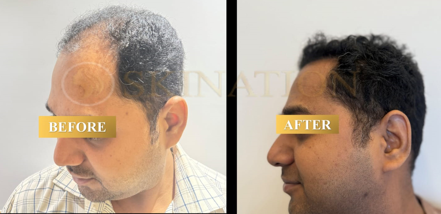 Hair Transplant in Chattarpur